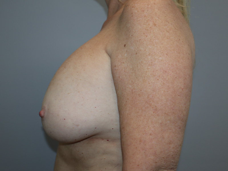 Breast Revision Before and After 70 | Grover Aesthetics