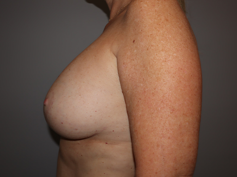 Breast Revision Before and After 70 | Grover Aesthetics