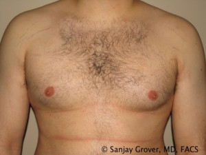 Gynecomastia Before and After 19 | Sanjay Grover MD FACS