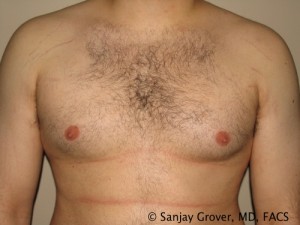 Gynecomastia Before and After | Grover Aesthetics