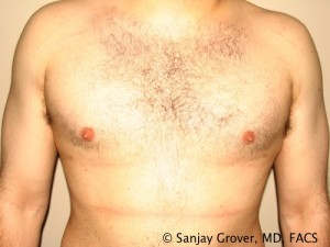 Gynecomastia Before and After | Grover Aesthetics