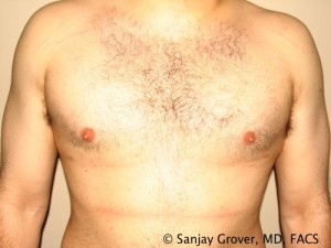 Gynecomastia Before and After | Sanjay Grover MD FACS