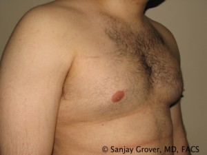 Gynecomastia Before and After 01 | Sanjay Grover MD FACS