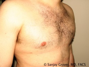 Gynecomastia Before and After 01 | Sanjay Grover MD FACS