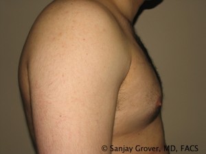 Gynecomastia Before and After 01 | Grover Aesthetics