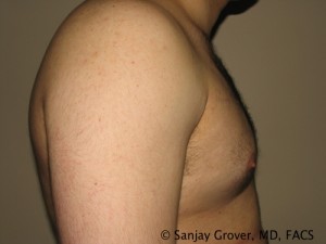 Gynecomastia Before and After 01 | Sanjay Grover MD FACS