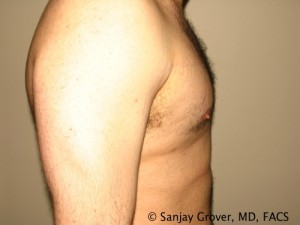 Gynecomastia Before and After 01 | Sanjay Grover MD FACS