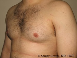 Gynecomastia Before and After 01 | Sanjay Grover MD FACS