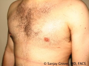 Gynecomastia Before and After 01 | Sanjay Grover MD FACS