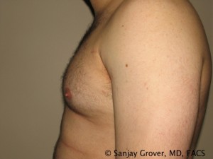 Gynecomastia Before and After 01 | Sanjay Grover MD FACS