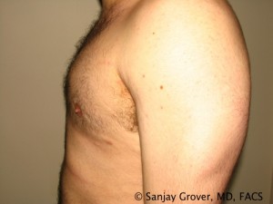 Gynecomastia Before and After 01 | Grover Aesthetics