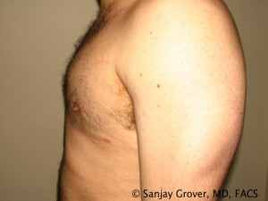 Gynecomastia Before and After 01 | Sanjay Grover MD FACS