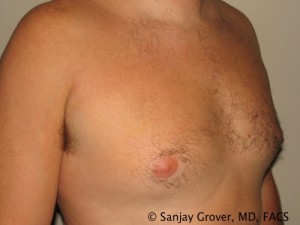 Gynecomastia Before and After 21 | Sanjay Grover MD FACS