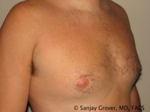 Gynecomastia Before and After | Grover Aesthetics