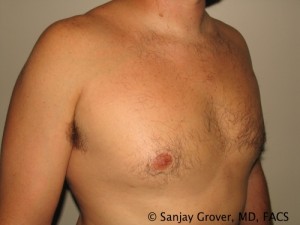 Gynecomastia Before and After | Grover Aesthetics