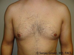 Gynecomastia Before and After | Grover Aesthetics