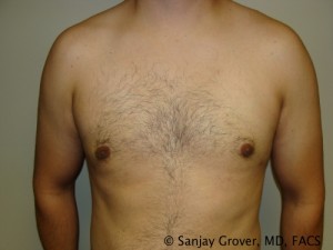 Gynecomastia Before and After | Grover Aesthetics