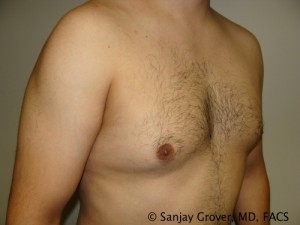 Gynecomastia Before and After 03 | Sanjay Grover MD FACS