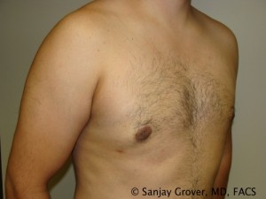 Gynecomastia Before and After 03 | Sanjay Grover MD FACS
