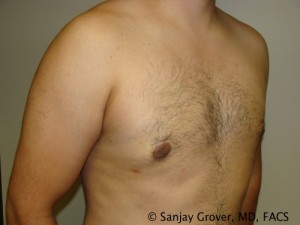 Gynecomastia Before and After 03 | Grover Aesthetics