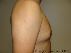 Gynecomastia Before and After 03 | Sanjay Grover MD FACS