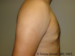 Gynecomastia Before and After 03 | Sanjay Grover MD FACS