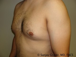 Gynecomastia Before and After 03 | Sanjay Grover MD FACS