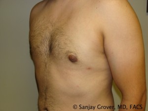 Gynecomastia Before and After 03 | Sanjay Grover MD FACS