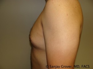 Gynecomastia Before and After 03 | Grover Aesthetics