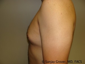 Gynecomastia Before and After 03 | Sanjay Grover MD FACS