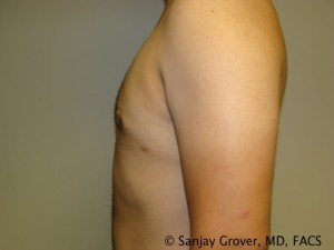 Gynecomastia Before and After 03 | Grover Aesthetics