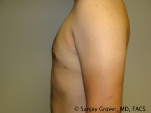 Gynecomastia Before and After 03 | Sanjay Grover MD FACS