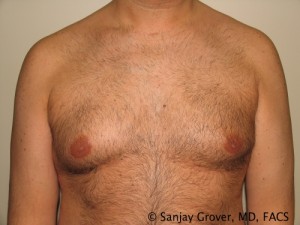 Gynecomastia Before and After | Grover Aesthetics
