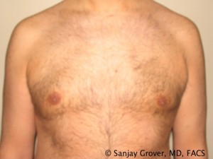 Gynecomastia Before and After | Grover Aesthetics