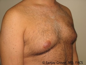 Gynecomastia Before and After 04 | Sanjay Grover MD FACS