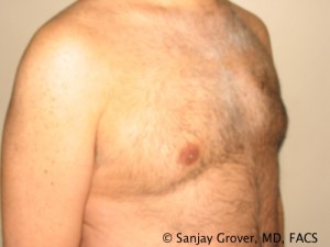 Gynecomastia Before and After 04 | Sanjay Grover MD FACS