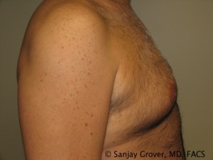 Gynecomastia Before and After 04 | Sanjay Grover MD FACS