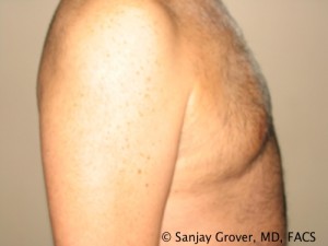 Gynecomastia Before and After 04 | Grover Aesthetics