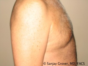 Gynecomastia Before and After 04 | Sanjay Grover MD FACS