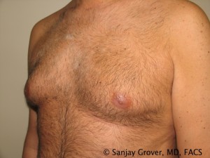 Gynecomastia Before and After 04 | Sanjay Grover MD FACS