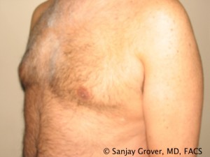 Gynecomastia Before and After 04 | Sanjay Grover MD FACS