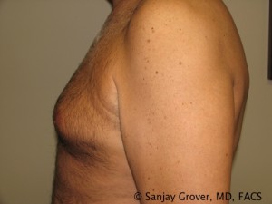 Gynecomastia Before and After 04 | Sanjay Grover MD FACS