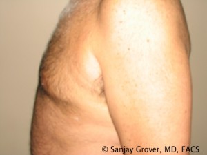 Gynecomastia Before and After 04 | Sanjay Grover MD FACS