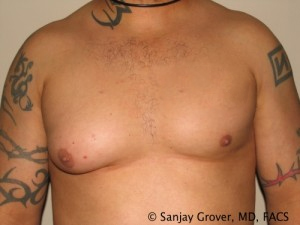 Gynecomastia Before and After | Grover Aesthetics