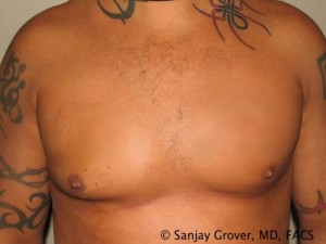 Gynecomastia Before and After | Grover Aesthetics