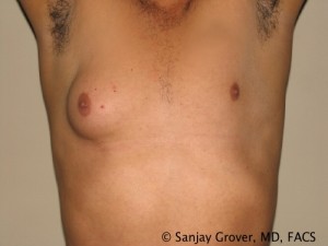 Gynecomastia Before and After 05 | Sanjay Grover MD FACS