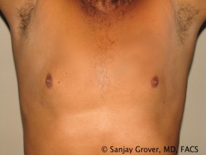 Gynecomastia Before and After 05 | Sanjay Grover MD FACS