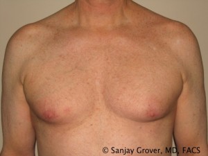Gynecomastia Before and After | Grover Aesthetics