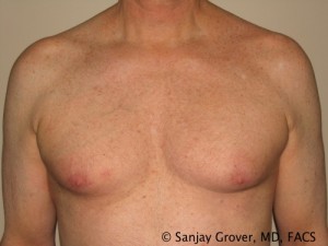 Gynecomastia Before and After 20 | Sanjay Grover MD FACS