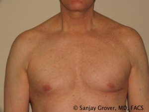 Gynecomastia Before and After | Grover Aesthetics